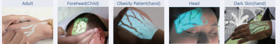 Alternative view of VeinSight Venen Finder, VS30